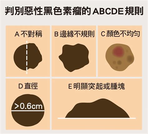 屁股長黑痣|這是痣，還是黑色素癌？醫師：這種斑最危險！